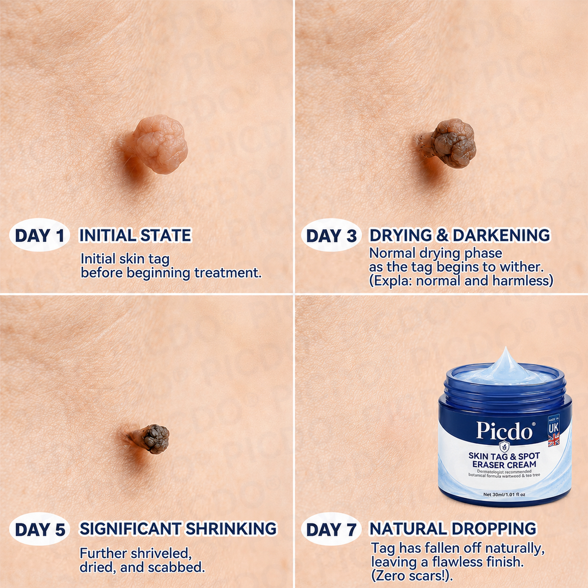 𝐏𝐢𝐜𝐝𝐨®🥇7-𝐃𝐚𝐲 𝐒𝐤𝐢𝐧 𝐓𝐚𝐠 & 𝐒𝐩𝐨𝐭 𝐄𝐫𝐚𝐬𝐞𝐫 𝐂𝐫𝐞𝐚𝐦(Zero Pain, Zero 𝐒𝐜𝐚𝐫𝐬 Formula)💎