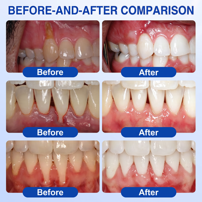 🇬🇧Glimmerly® 🦷GumRevive periodontal repair gel🍀