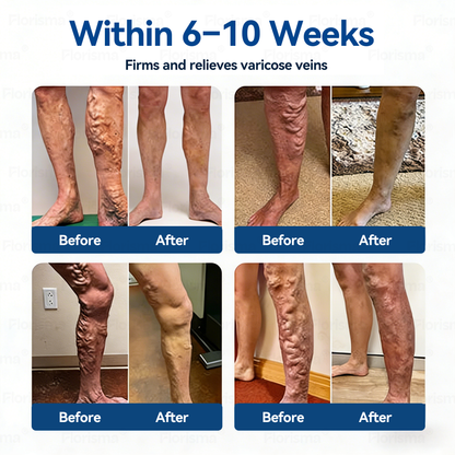 One Patch a Day. Visible Vein Relief in Just 7 Days 👨‍⚕️ 𝑭𝑳𝑶𝑹𝑰𝑺𝑴𝑨® 𝑫𝑰𝑶𝑺𝑴𝑰𝑵 & 𝑯𝑬𝑺𝑷𝑬𝑹𝑰𝑫𝑰𝑵 𝑪𝒍𝒊𝒏𝒊𝒄𝒂𝒍-𝑮𝒓𝒂𝒅𝒆 𝑭𝒐𝒓𝒎𝒖𝒍𝒂 𝑴𝒊𝒄𝒓𝒐𝒏𝒆𝒆𝒅𝒍𝒆 𝑷𝒂𝒕𝒄𝒉  🌳 𝗔𝗱𝘃𝗮𝗻𝗰𝗲𝗱 𝗛𝗲𝗿𝗯𝗮𝗹 𝗕𝗹𝗲𝗻𝗱 𝗧𝗮𝗿𝗴𝗲𝘁𝘀 𝗦𝗽𝗶𝗱𝗲𝗿 𝗩𝗲𝗶𝗻𝘀 & 𝗥𝗲𝗹𝗶𝗲𝘃𝗲𝘀 𝗛𝗲𝗮𝘃𝘆, 𝗧𝗶𝗿𝗲𝗱 𝗟𝗲𝗴𝘀美国别复制