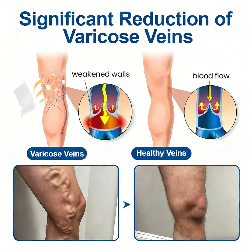 One Patch a Day. Visible Vein Relief in Just 7 Days 👨‍⚕️ Florisma® VeinTarget Microneedle Patch 🍀 Instant Relief, Long-Term Results