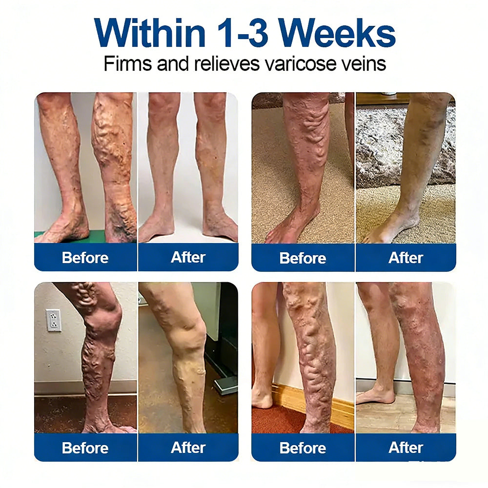 One Patch a Day. Visible Vein Relief in Just 7 Days 👨‍⚕️ Florisma® VeinTarget Microneedle Patch 🍀 Instant Relief, Long-Term Results
