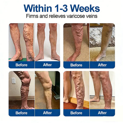 One Patch a Day. Visible Vein Relief in Just 7 Days 👨‍⚕️ Florisma® VeinTarget Microneedle Patch 🍀 Instant Relief, Long-Term Results