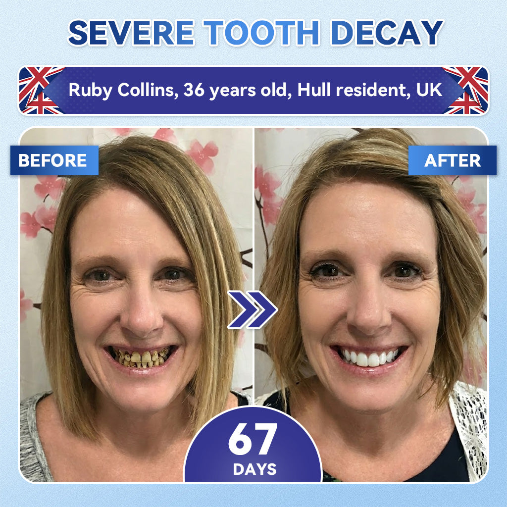 Glimmerly® 🦷 Tideglusib Fast‑Dissolving Tooth & Gum Repair Oral Strips 🔊 (Supports tooth repair and helps relieve gum discomfort and other common oral concerns)