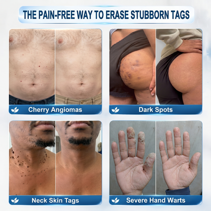 𝐎𝐟𝐟𝐢𝐜𝐢𝐚𝐥 𝐁𝐫𝐚𝐧𝐝 𝐒𝐭𝐨𝐫𝐞 🥇 𝐏i𝐜𝐝o® 7-𝐷𝑎𝑦 𝗧𝐚𝐠 & 𝗦𝗽𝐨𝐭 𝐄𝐫𝒂𝒔𝒆𝒓(Zero Pain, Zero 𝐒𝐜𝐚𝒓𝒔 Rollerball)🌈