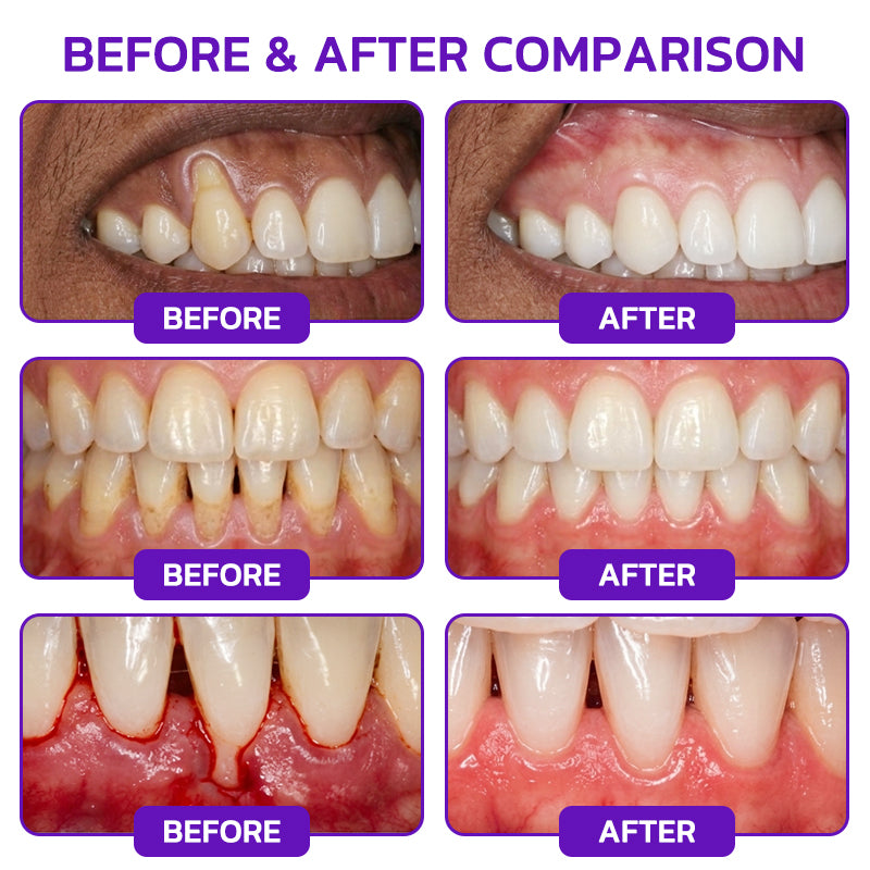 Glimmerly®🦷 VioCore Bee Venom Gingivitis & Periodontitis Treatment Toothpaste❄️