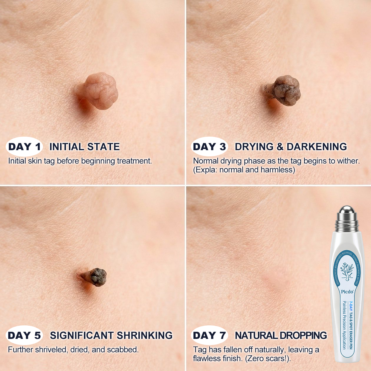 𝐎𝐟𝐟𝐢𝐜𝐢𝐚𝐥 𝐁𝐫𝐚𝐧𝐝 𝐒𝐭𝐨𝐫𝐞 🥇 𝐏i𝐜𝐝o® 7-𝐷𝑎𝑦 𝗧𝐚𝐠 & 𝗦𝗽𝐨𝐭 𝐄𝐫𝒂𝒔𝒆𝒓(Zero Pain, Zero 𝐒𝐜𝐚𝒓𝒔 Rollerball)🌈