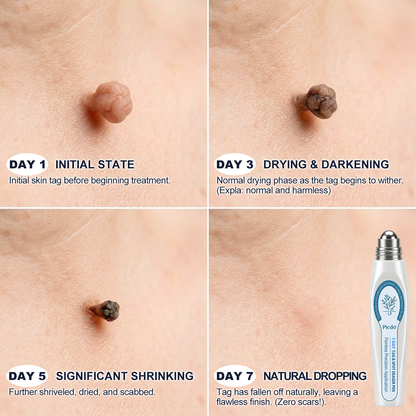 𝐎𝐟𝐟𝐢𝐜𝐢𝐚𝐥 𝐁𝐫𝐚𝐧𝐝 𝐒𝐭𝐨𝐫𝐞 🥇 𝐏i𝐜𝐝o® 7-𝐷𝑎𝑦 𝗧𝐚𝐠 & 𝗦𝗽𝐨𝐭 𝐄𝐫𝒂𝒔𝒆𝒓(Zero Pain, Zero 𝐒𝐜𝐚𝒓𝒔 Rollerball)🌈